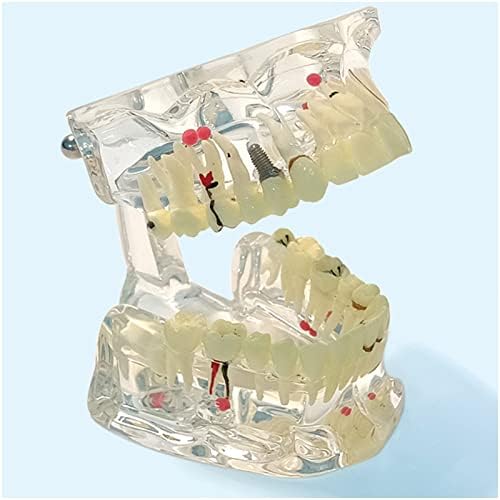 מודל שיני שיניים שיניים של KH66Zky, מודל הדגמת פתולוגיה מקיפה לשיניים, לחינוך, תקשורת, למידה ומעבדה