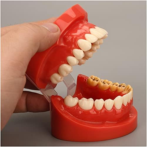 66זקי שיניים עששת שן דגם-עששת דגם - סטנדרטי שיניים הוראת דגם מחקר כלי למבוגרים מחלה סטנדרטי טיפודונט